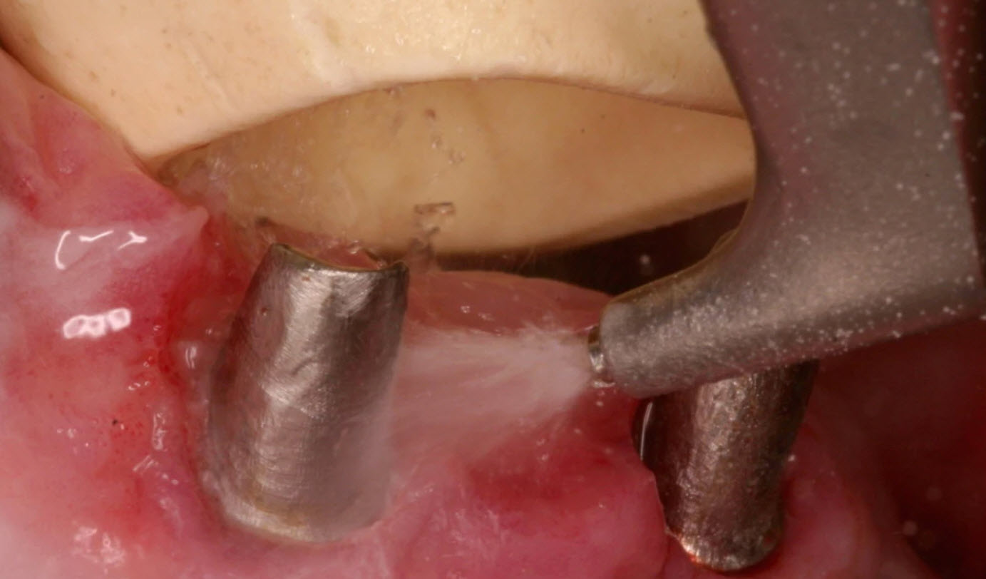 Peri-Implantitis: What Causes Implant Failure? | 3Sixty